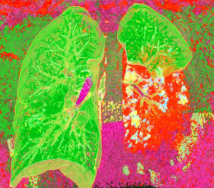 A colored CT scan of the chest, shows red obscuring half of the right lung, which indicates a bacterial infection