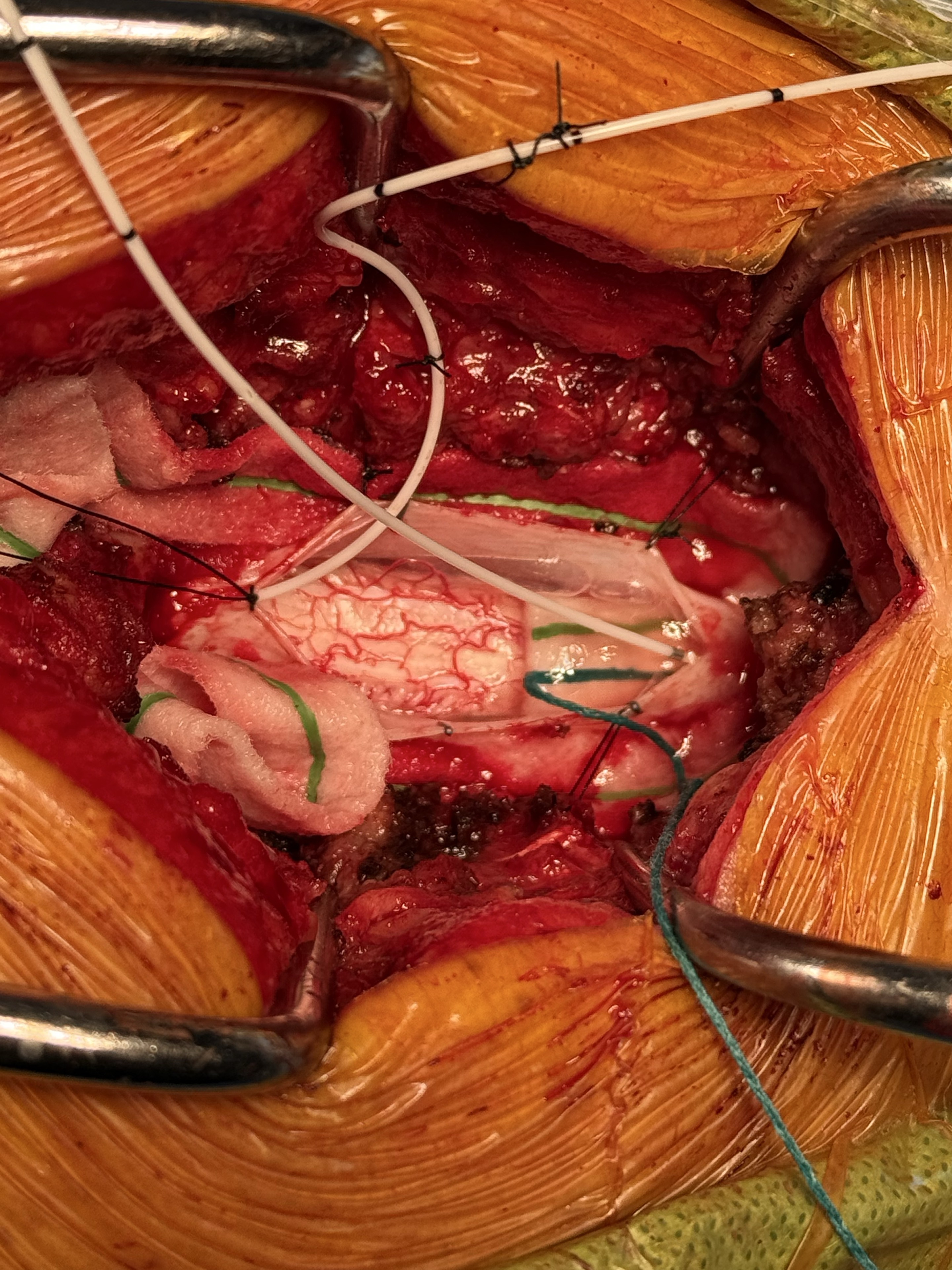 Operative view of an exposed spinal cord with recording leads visible