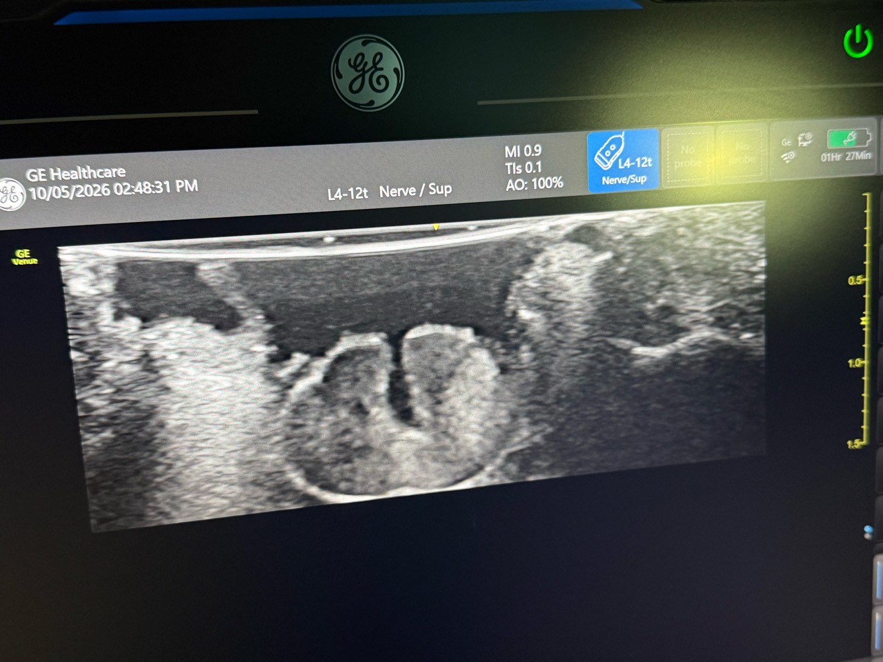 Ultrasound view during spinal cord surgery