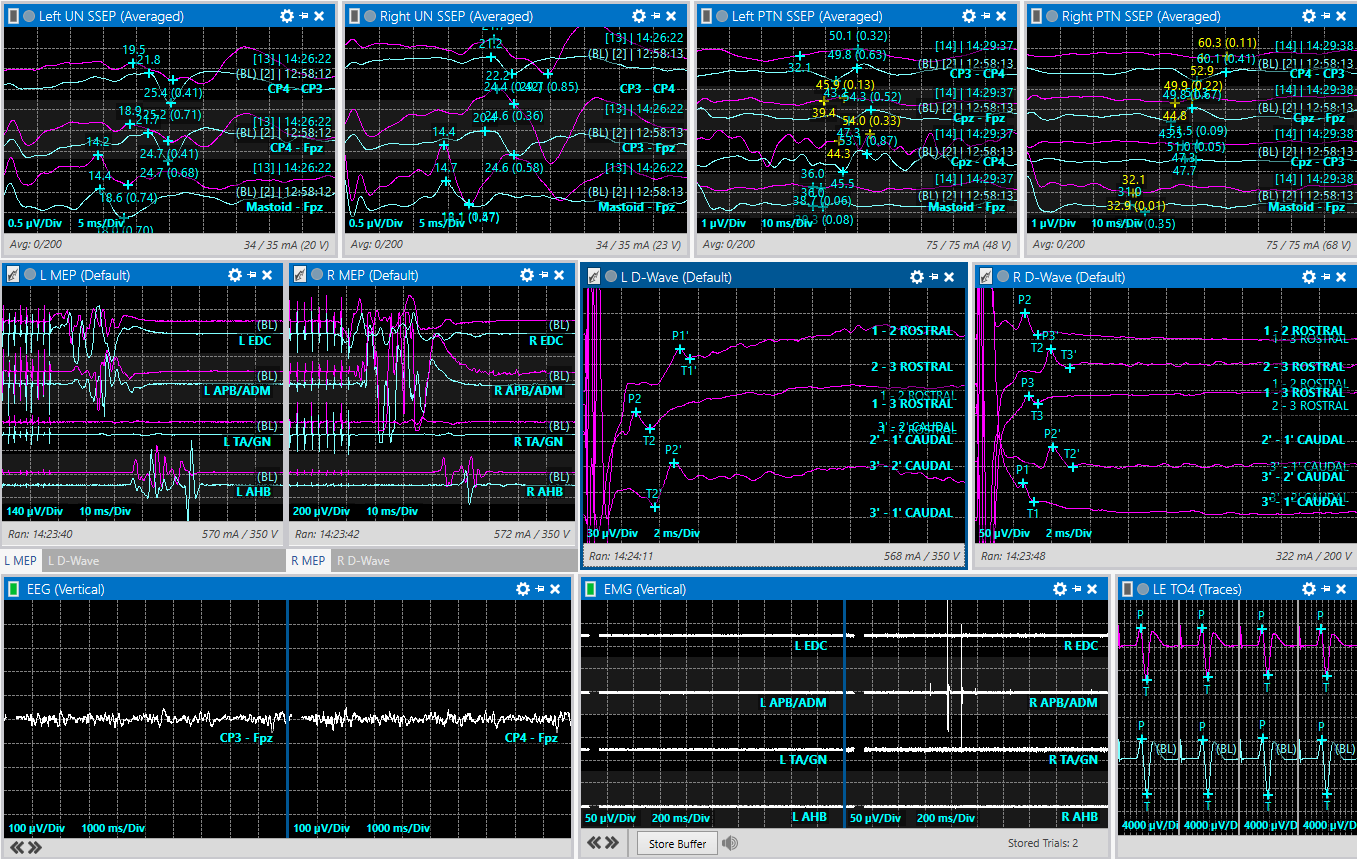 Monitoring screen showing D-wave recordings above and below the surgical region alongside other nerve monitoring signals